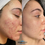 Thumbnail: the best chemical peel in Vaughan and Toronto. chemical peel near me.