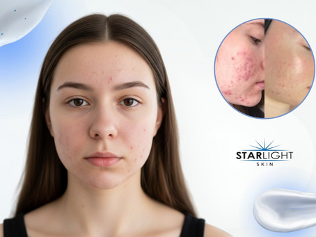 What to do When Your Teenager has Acne and You Want to Skip Medications
