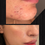 Thumbnail: the best chemical peel in Vaughan and Toronto. chemical peel near me.