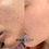 Thumbnail: best microneedling in Vaughan and Toronto