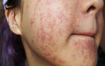 Nổi mề đay nhưng không ngứa là dấu hiệu gì? Tìm hiểu nguyên nhân theo Đông y và cách cải thiện an toàn từ Nhà thuốc Nam dược gia truyền Thuận Đức.