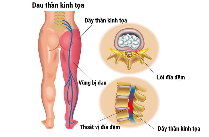 Đau lưng lan xuống chân, tê bì chân có thể là dấu hiệu đau thần kinh tọa. Tìm hiểu nguyên nhân và cách cải thiện theo Đông y tại Nhà thuốc Nam Dược Gia Truyền Thuận Đức.
