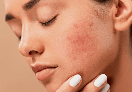 Your Skin Is Not the Problem  Sometimes It’s the Stress Behind It