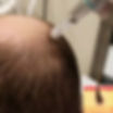 Hair-Restoration-Microneedling.jpg