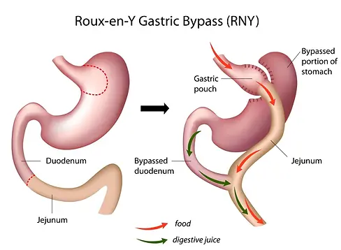 roux-en-y-gastric-bypass1_B92654CF-0337-3E7B-868F3E4F4D70CDF7.webp