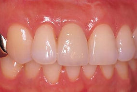 dental implant