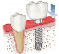 ImplantIllustration6.gif