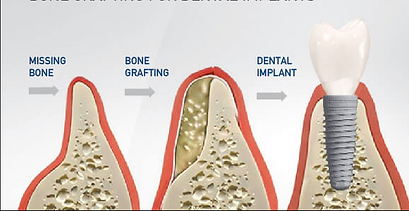dental implants chandigarh
