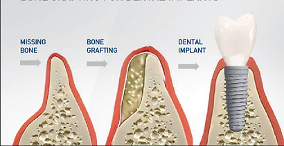 dental implants chandigarh