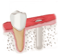 ImplantIllustration2.gif