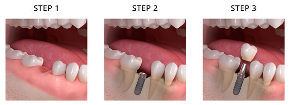 dental implants chandigarh, nobel biocare implants chandigarh
