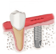 ImplantIllustration4.gif