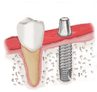 ImplantIllustration5.gif