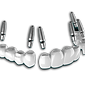 3-on-6-dental-implants-in-mexico-by-dr-moguel