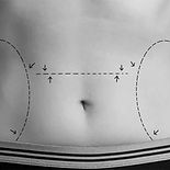 abdominoplastia-miniabdominoplastia-1200x720_edited.jpg