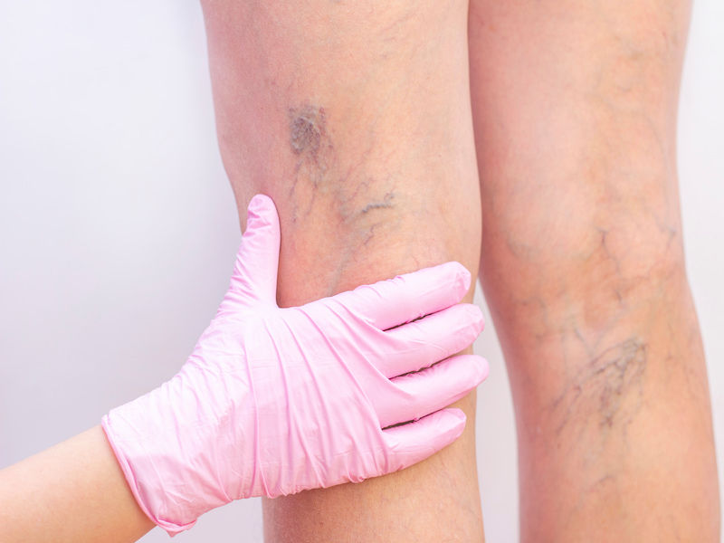 Spider-vein-treatment-dubai.jpg