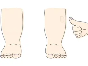 Leg swelling (Edema)