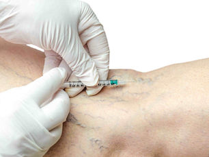 Spider vein sclerotherapy