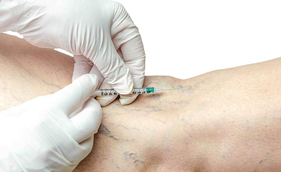 Sclerotherapy Spider Veins