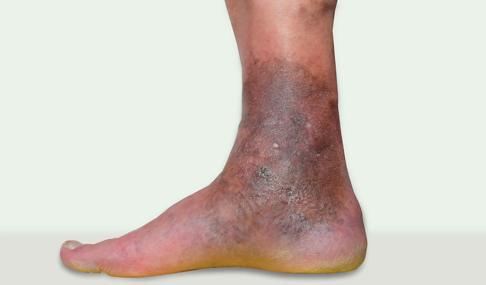 Lipodermatosclerosis