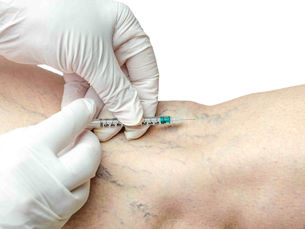 Is Sclerotherapy Safe for Treating Spider Veins in Dubai?