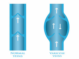 ClariVein® (MOCA): A Modern, Gentle Option for Treating Varicose Veins