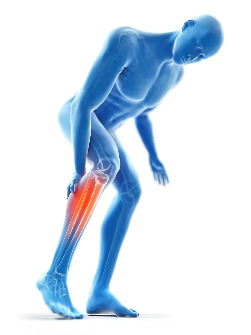 Intermittnet Claudication (1).webp