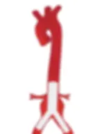 Abdominal aortic aneurysm.webp