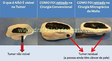 Como realizar cirurgia micrografica jundiai Dra Fabiola Leme