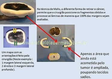 Como realizar cirurgia micrografica de mohs tratamento jundiai Dra Fabiola Leme