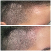 Scalp micropigmentation 
