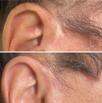 face lift scar cover up.jpg