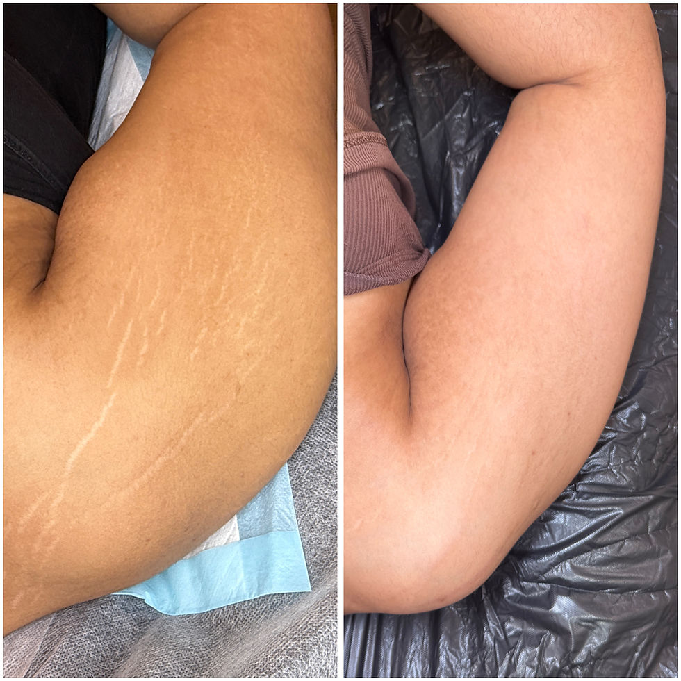 A woman's legs with stretch marks.