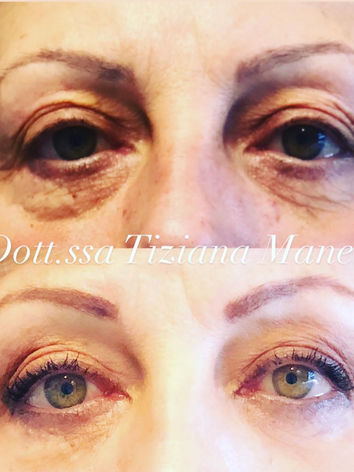 Technique non chirurgicale de lifting des sourcils à l'acide hyaluronique