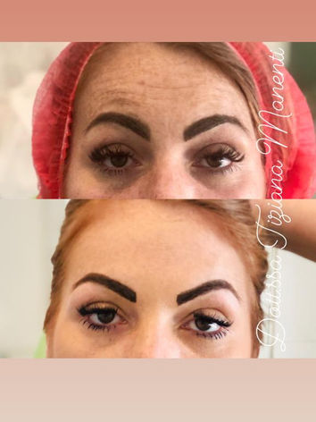 Traitement des yeux du front avec la toxine botulique (BOTOX)