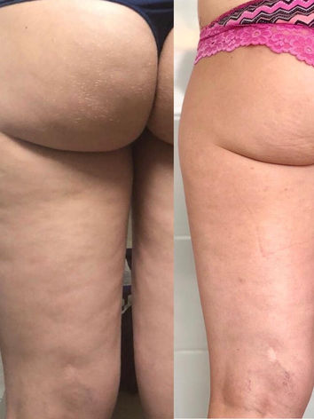 Traitement par injection avec mésothérapie de dernière génération. Les enzymes Adiposité plus Cellulite