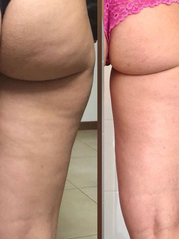 Traitement par injection avec mésothérapie de dernière génération. Les enzymes Adiposité plus Cellulite