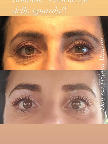 Soin du front et du contour des yeux à la Toxine Botulique