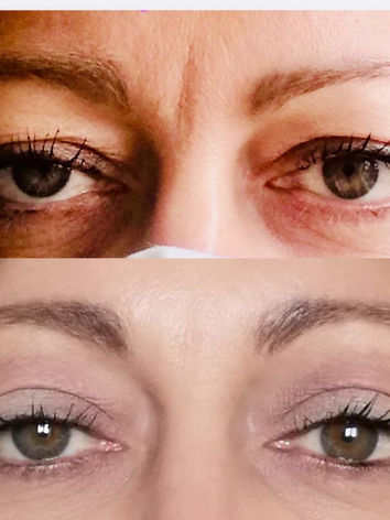 Blépharoplastie non chirurgicale au laser plasma
