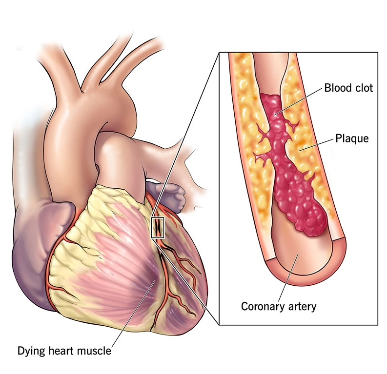 A fully obstructed artery prevents blood flow, leading to a heart attack