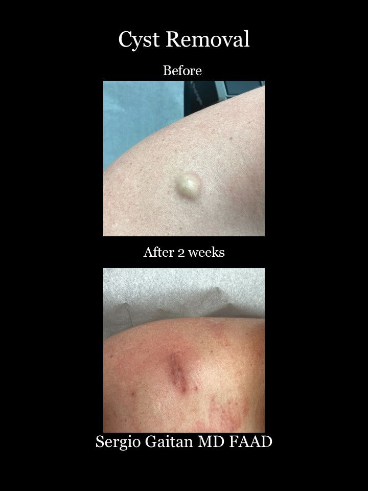 Cyst Removal Miami Shoulde