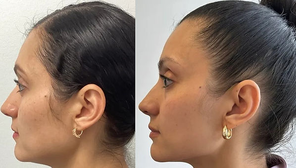 skin tightening miami before and after laser microneedling facial