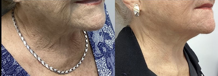 skin tightening miami before and after laser microneedling facial