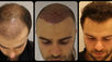 How to locate Best Hair Transplant Clinic in Delhi