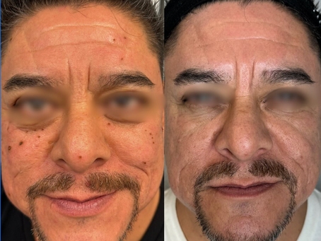 The Ultimate Guide to Fibroblast Plasma Treatment in Las Vegas: Your Key to Tighter, Younger-Looking Skin
