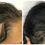 Miniature : Micropigmentation Capillaire Femme