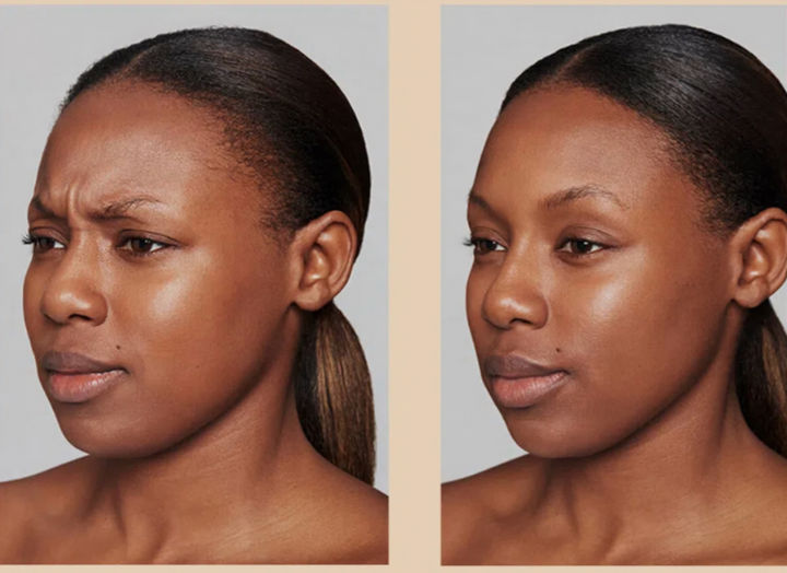 Dysport before and after at Nuderma Med Spa