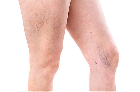 Spider Veins.jpeg