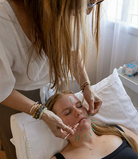 cosmetic acupuncture brisbane.JPG