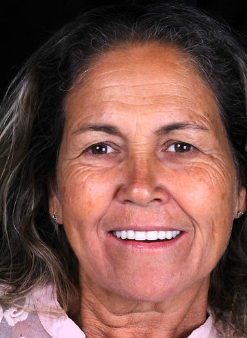 sorriso com implantes